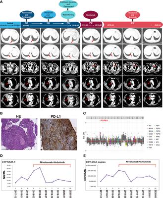 Case Report: Anlotinib Reverses Nivolumab Resistance in Advanced Primary Pulmonary Lymphoepithelioma-Like Carcinoma With FGFR3 Gene Amplification